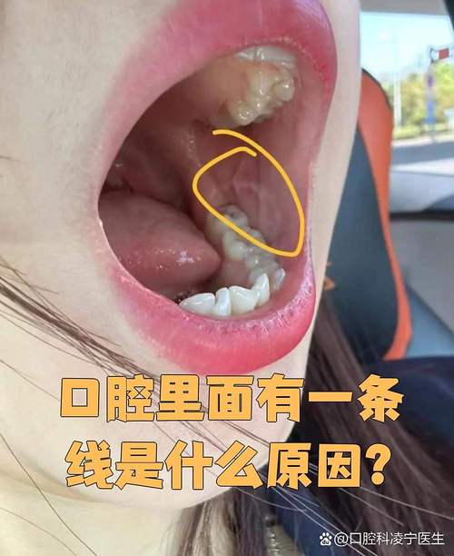 口腔上颚中间白线是啥?正常吗?