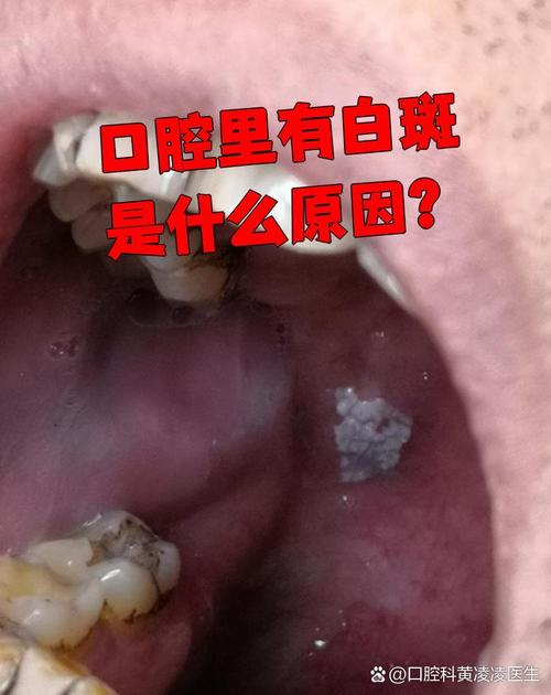 口腔毛状白斑如何准确确认?