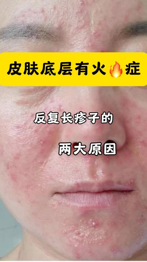皮肤底层炎症难治?根源怎么找?