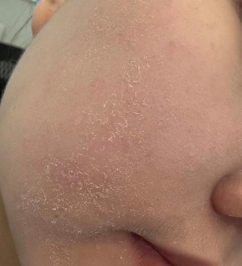 冬天脸干起皮,怎么快速补水修复?