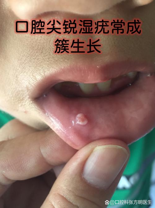 口腔尖锐湿疣哪种疗法最有效?