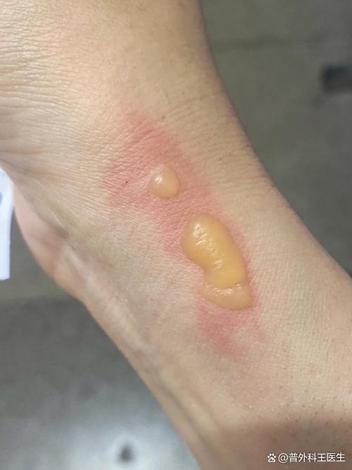 烫伤后红肿疼痛,如何快速缓解?