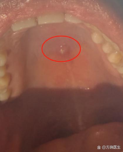 口腔上颚长牙是何病理原因?