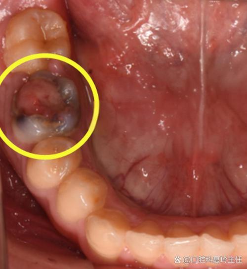 口腔上颚长牙是何病理原因?