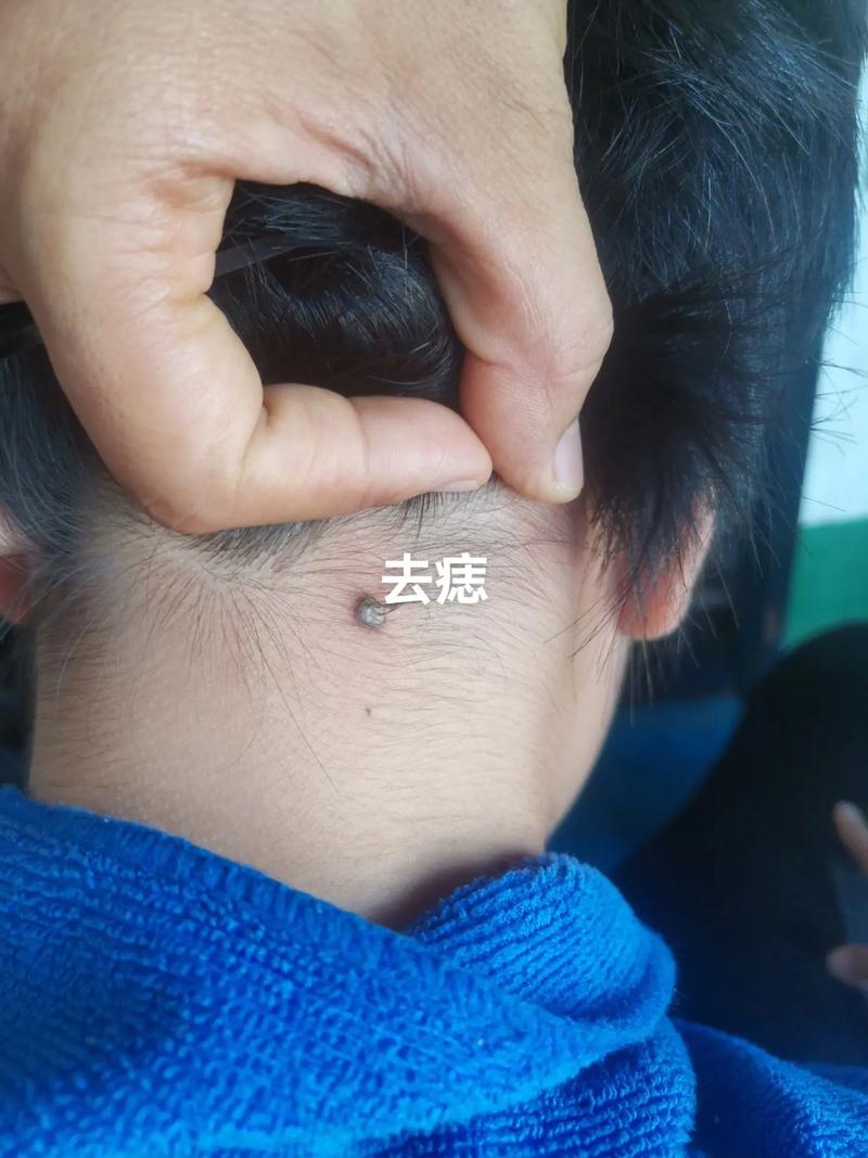 南京皮肤病研究所点痣