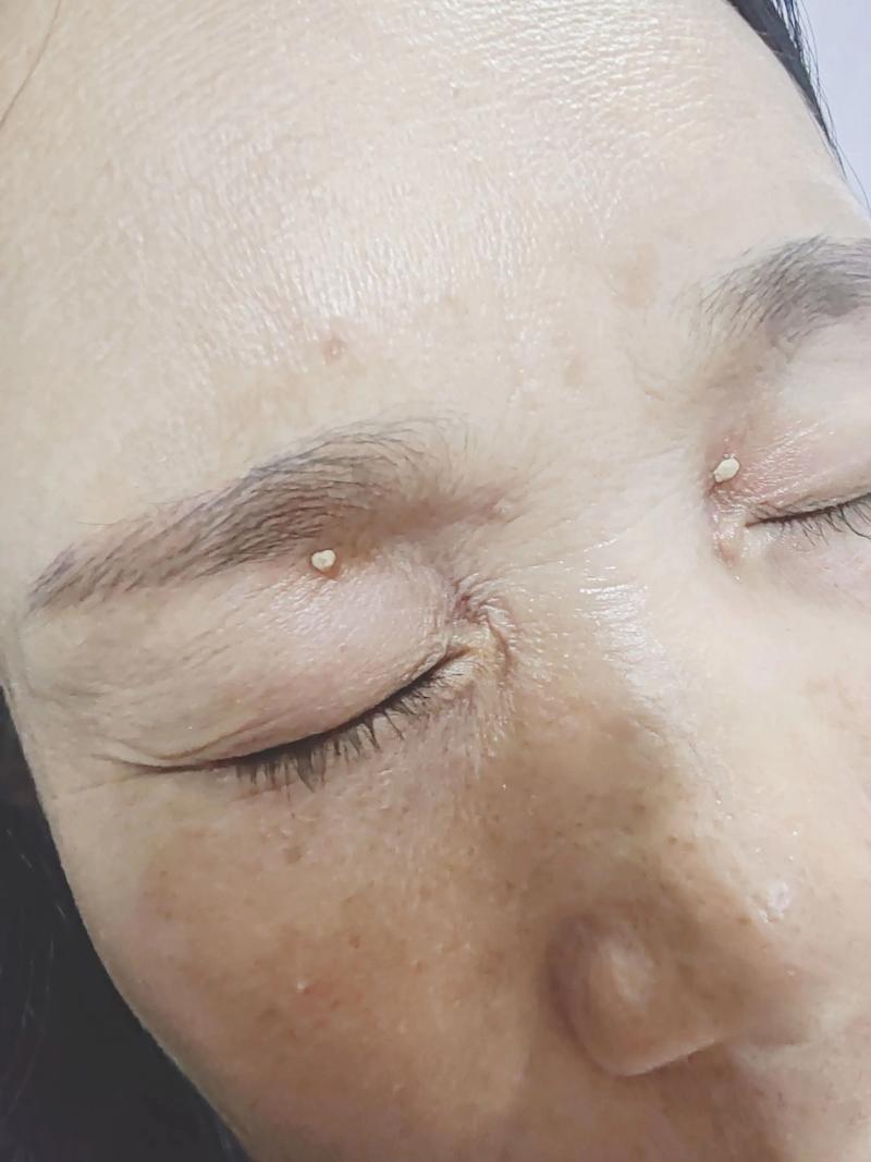 南京皮肤病研究所点痣